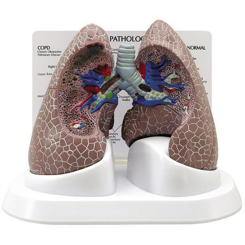 Lung Cancer Model - Normal + 3 Conditions - 030c08a0a9caba7c3674e6d00d87ebfc