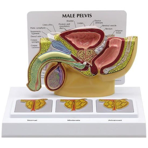 Male Pelvis Model - Cross Section with 3D Enlarged Prostates - 11c3d7c03575dcd07a83525e2c4d7ed6