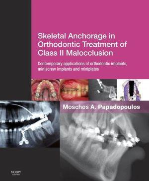 Skeletal Anchorage in Orthodontic Treatment of Class II Malocclusion - 56c919d1b3688383e1f4699a31d306fa