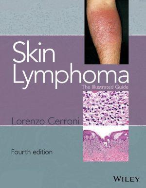 Skin Lymphoma - The Illustrated Guide 4e - 65e089993b672e74995a1b212fc9bece