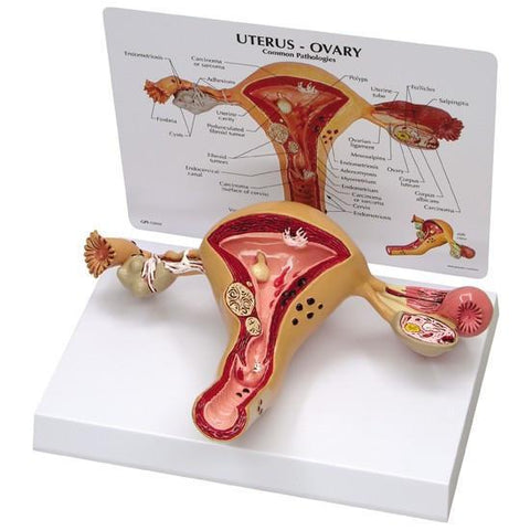 Uterus/Ovary Model with Pathologies - 954dd41a50e4c857c609230ad68dd417