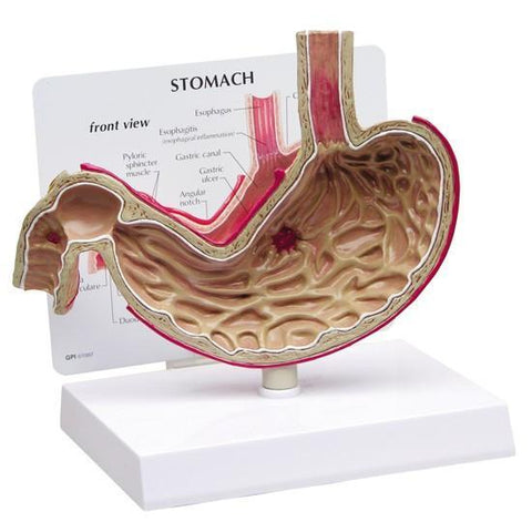 Stomach with Ulcers Model - 9f876788a75fbe81f01ac6efa83e9e6d