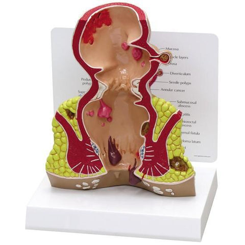 Rectum Model - Cross Section (oversize) with Pathologies - b6b38321c430d50b464d3fb21aec7d2f