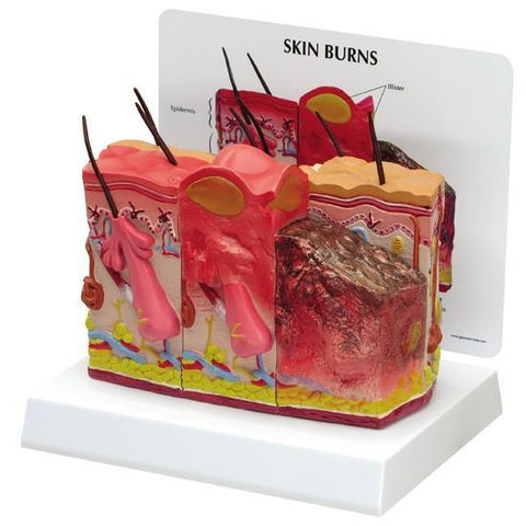 Skin with Burns Model - f08ddb39c3c5b48a4870a7d4125f0e88